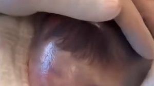HT20. Baby born with an DIU peg… See more