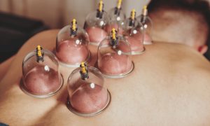 ST20. What Is Cupping Therapy? Benefits, Types, and Safety Tips
